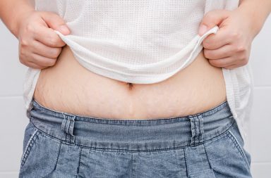 Wszystko, co należy wiedzieć o rozstępach – powstawanie, zapobieganie, usuwanie